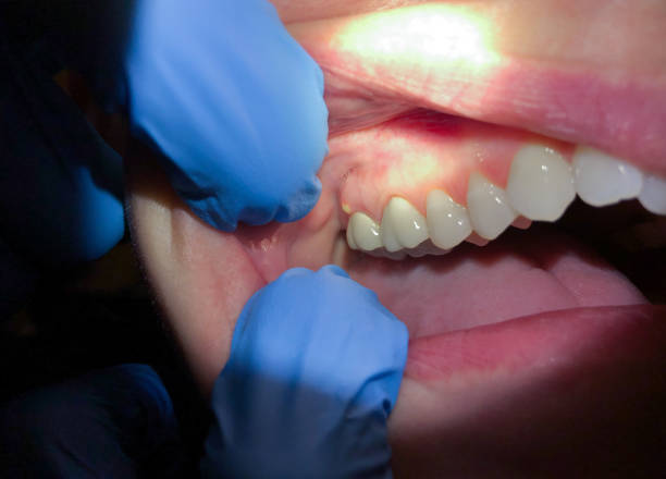 Best Emergency Treatment for Dental Infections or Abscesses in Attleboro, MA